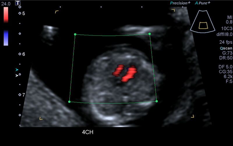 File:1st trimester nuchal-morphology ultrasound (Radiopaedia 44706-48477 Heart views cine with colour 41).jpg