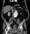 Abdominal aortic aneurysm (Radiopaedia 25855-26001 Coronal C+ arterial phase 35).jpg