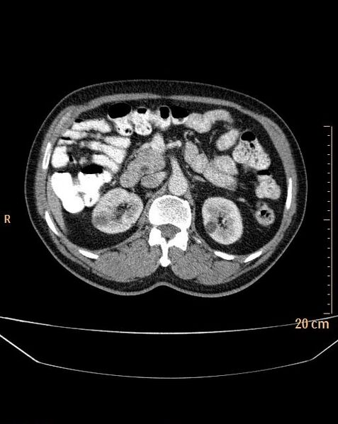 File:Abdominal aortic aneurysm (Radiopaedia 25985-26121 Axial C+ arterial phase 6).jpg