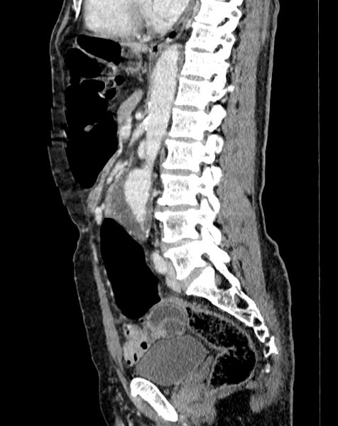 File:Abdominal aortic aneurysm (Radiopaedia 83581-98689 Sagittal C+ portal venous phase 60).jpg