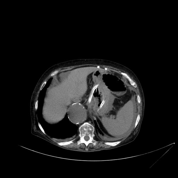 File:Abdominal aortic aneurysm - impending rupture (Radiopaedia 19233-19246 Axial non-contrast 26).jpg