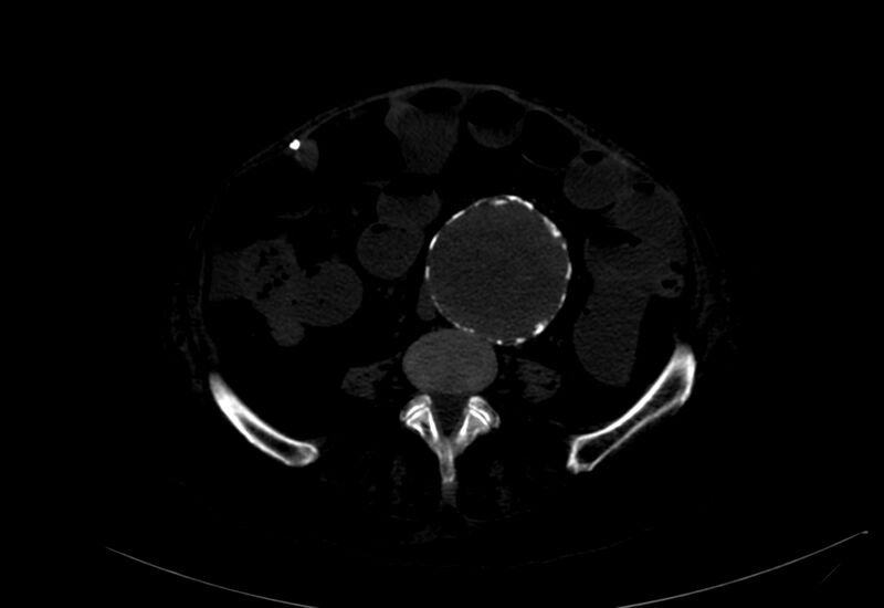 File:Abdominal aortic aneurysm - impending rupture (Radiopaedia 19233-19246 B 28).jpg