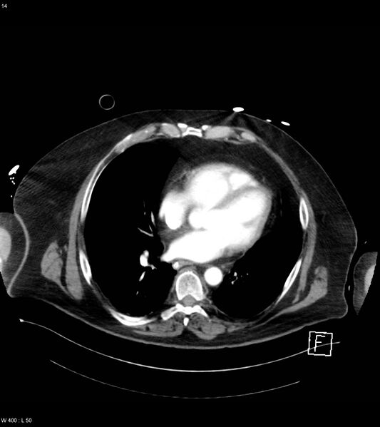 File:Abdominal aortic aneurysm with intramural hematoma then rupture (Radiopaedia 50278-55632 Axial C+ arterial phase 13).jpg