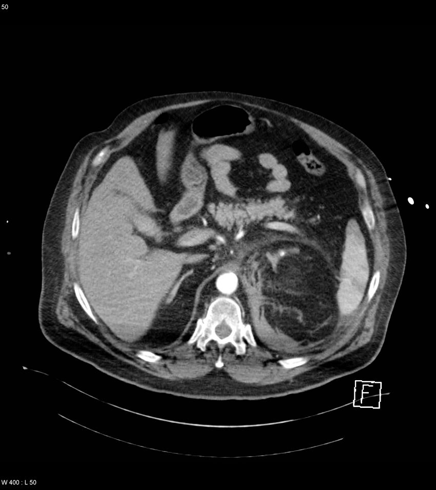 Abdominal aortic aneurysm with intramural hematoma then rupture (Radiopaedia 50278-55632 Axial C+ arterial phase 49).jpg