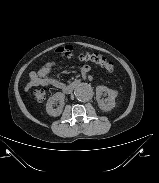 File:Abdominal aortic aneurysm with thrombus fissuration (Radiopaedia 46218-50618 Axial non-contrast 25).jpg