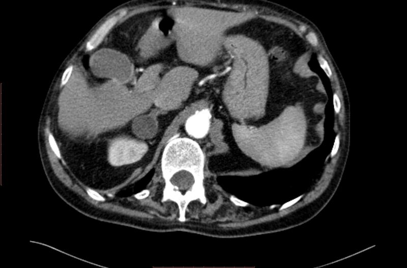 File:Abdominal aortic interposition tube graft and aneurysm thrombosis (Radiopaedia 71438-81857 Axial C+ arterial phase 9).jpg