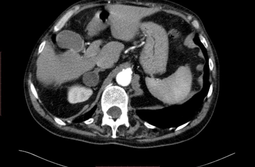 Abdominal aortic interposition tube graft and aneurysm thrombosis (Radiopaedia 71438-81857 Axial C+ arterial phase 9).jpg