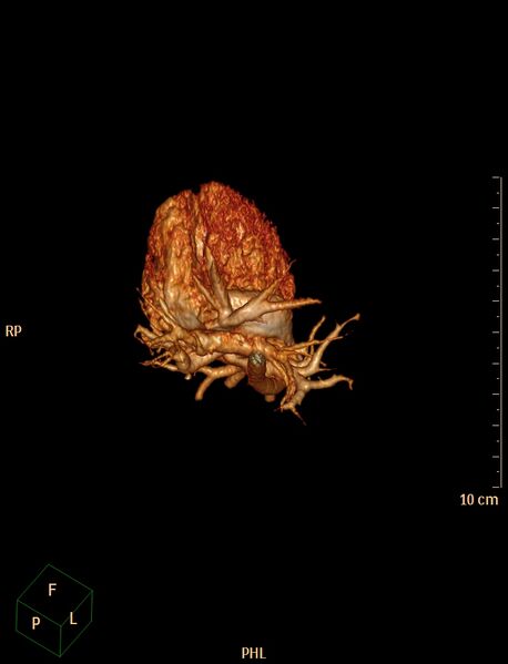 File:Aberrant left pulmonary artery (pulmonary sling) (Radiopaedia 42323-45435 3D reconstruction C+ CTPA 12).jpg