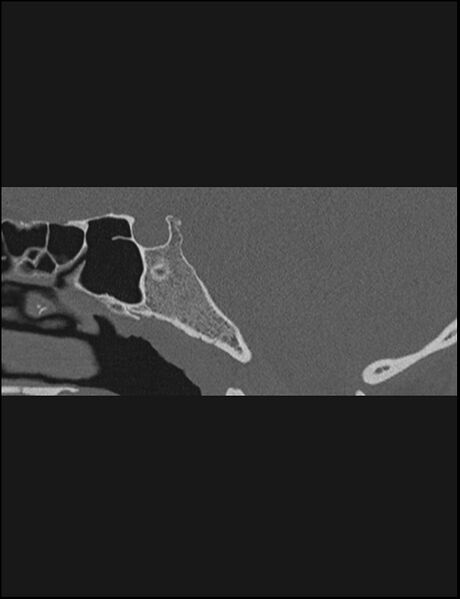 File:Aberrant right internal carotid artery (Radiopaedia 65191-74198 Sagittal non-contrast 98).jpg