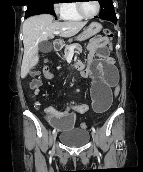 File:Active Crohn disease (Radiopaedia 59394-66750 Coronal C+ portal venous phase 32).jpg