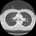 Active right ventricular cardiac sarcoidosis (Radiopaedia 55596-62101 Axial lung window 15).jpg