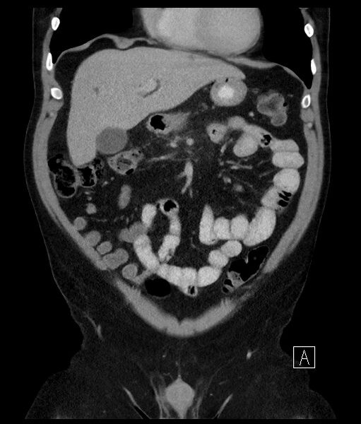 File:Acute-on-chronic pancreatitis (Radiopaedia 67286-76656 Coronal C+ portal venous phase 29).jpg