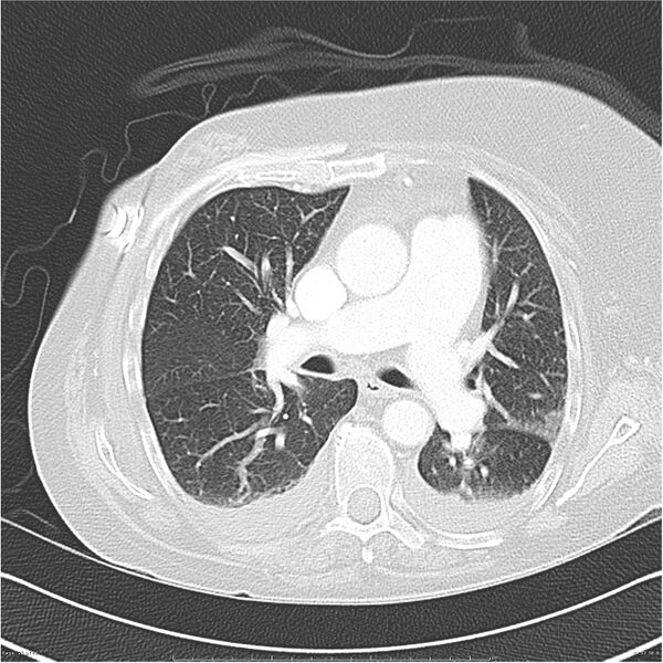 File:Acute-on-chronic pulmonary emboli (Radiopaedia 27925-28169 lung window 22).jpg