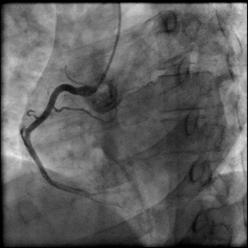 Acute anteroseptal myocardial infarction (Radiopaedia 68409-77946 RAO straight RCA 16).jpg