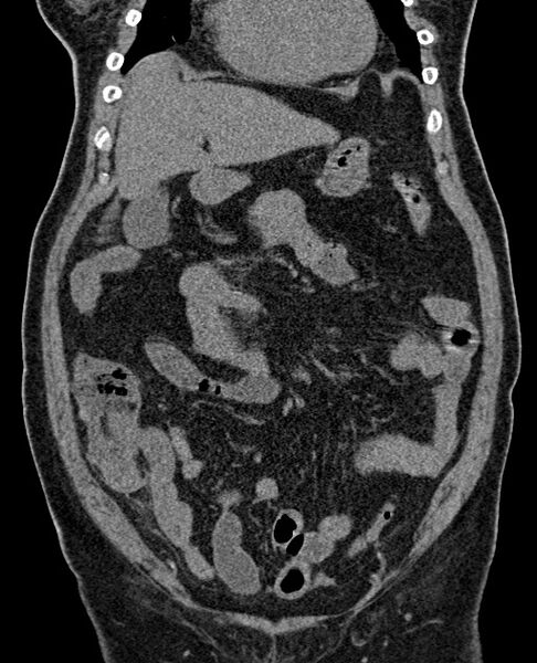 File:Acute appendicitis (Radiopaedia 58627-65818 Coronal non-contrast 31).jpg