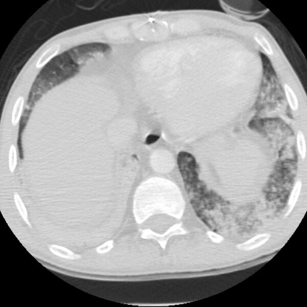 File:Acute diffuse alveolar hemorrhage (Radiopaedia 41323-44158 Axial lung window 53).jpg