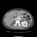 Acute myocarditis (Radiopaedia 55988-62613 Axial C+ portal venous phase 26).jpg