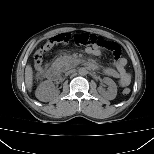 File:Acute pancreatitis (Radiopaedia 22572-22596 Axial non-contrast 26).jpg