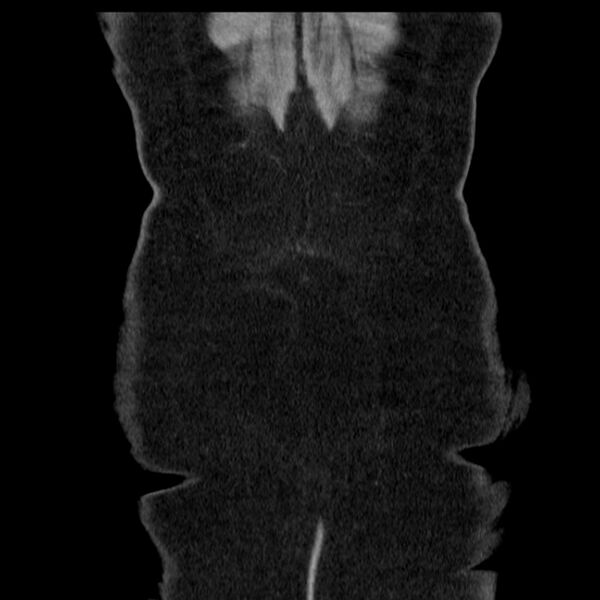 File:Acute pancreatitis - Balthazar C (Radiopaedia 26569-26714 Coronal C+ portal venous phase 68).jpg