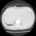 Acute pulmonary edema on CT (Radiopaedia 33582-34672 Axial lung window 50).jpg