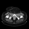 Acute pyelonephritis (Radiopaedia 25657-25837 Axial renal parenchymal phase 84).jpg