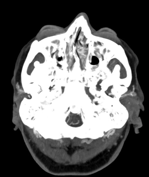 File:Acute right MCA M1 occlusion (Radiopaedia 62268-70454 Axial Phase 2 30).jpg