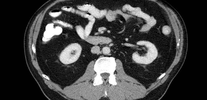 Acute sigmoid colon diverticulitis (Radiopaedia 55507-61976 Axial C+ portal venous phase 3).jpg
