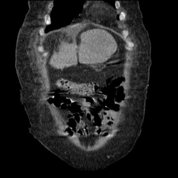 File:Acute tubular necrosis (Radiopaedia 28077-28334 G 19).jpg