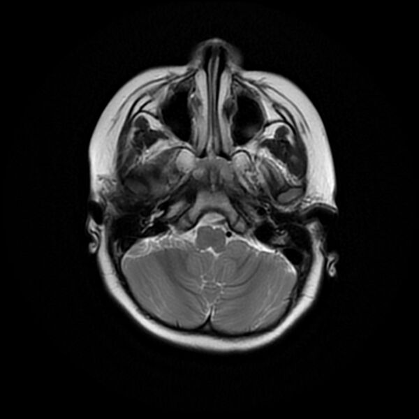 File:Adamantinomatous craniopharyngioma (Radiopaedia 77407-89529 Axial T2 5).jpg