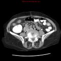 Adenocarcinoma of the colon (Radiopaedia 8191-9039 Axial renal excretory phase 33).jpg