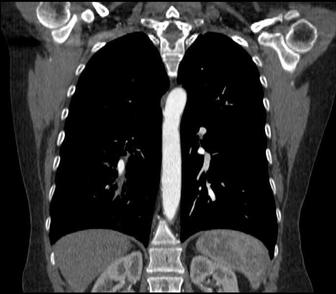 File:Adenocarcinoma of the lung (Radiopaedia 44205-47803 Coronal C+ portal venous phase 62).jpg