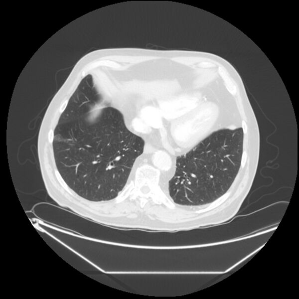 File:Adenocarcinoma of the lung (Radiopaedia 44876-48759 Axial lung window 60).jpg