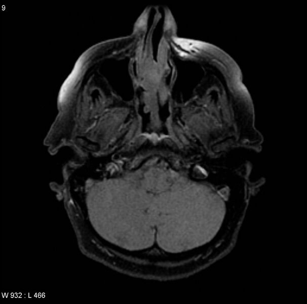 File:Adenoid cystic carcinoma (nasal septum) (Radiopaedia 4547-6668 Axial T1 fat sat 1).jpg