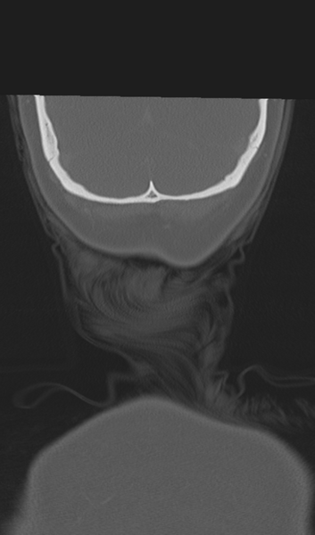 File:Adenoid cystic tumor of palate (Radiopaedia 46980-51518 Coronal bone window 61).png