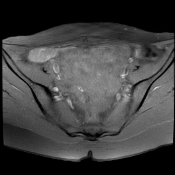 File:Adenomyosis within a septate uterus (Radiopaedia 69963-79981 Axial T1 fat sat 12).jpg