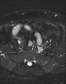 Adnexal multilocular cyst (O-RADS US 3- O-RADS MRI 3) (Radiopaedia 87426-103754 Axial T2 fat sat 4).jpg