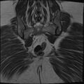 Adnexal multilocular cyst (O-RADS US 3- O-RADS MRI 3) (Radiopaedia 87426-103754 Coronal T2 29).jpg