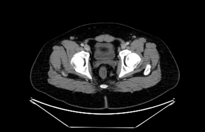 File:Adrenocortical carcinoma (Radiopaedia 80134-93438 Axial C+ portal venous phase 125).jpg
