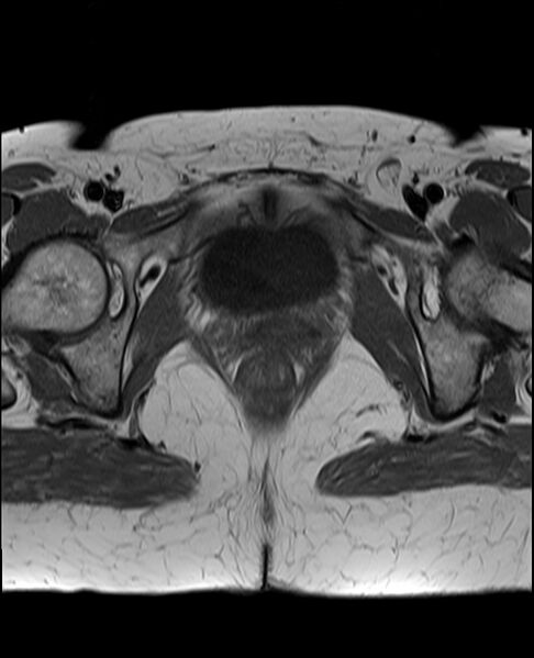 File:Adult granulosa cell tumor of the ovary (Radiopaedia 71581-81950 Axial T1 22).jpg