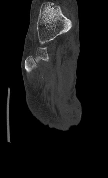 File:Advanced osteomyelitis due to open metatarsal fracture (Radiopaedia 83891-99095 Coronal bone window 15).jpg