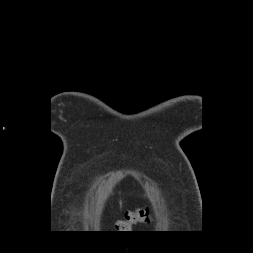 Agenesis of the left hepatic lobe (Radiopaedia 77284-89359 Coronal C+ CTPA 83).jpg