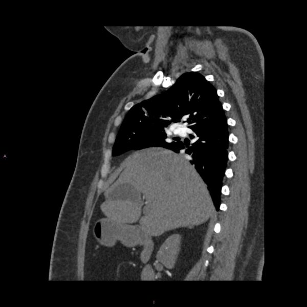 File:Agenesis of the left hepatic lobe (Radiopaedia 77284-89359 Sagittal C+ CTPA 40).jpg
