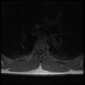 Aggressive vertebral hemangioma (Radiopaedia 39937-42404 Axial T1 24).png