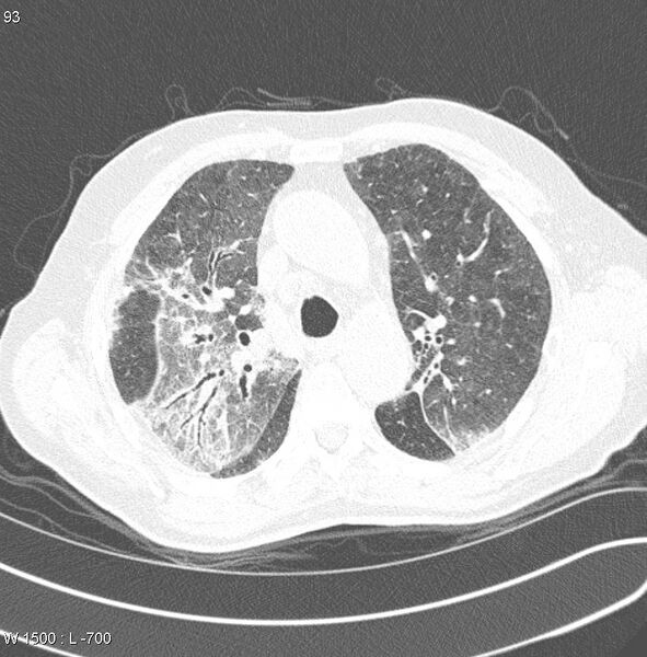 File:Amiodarone lung (Radiopaedia 6539-7851 Axial lung window 9).jpg