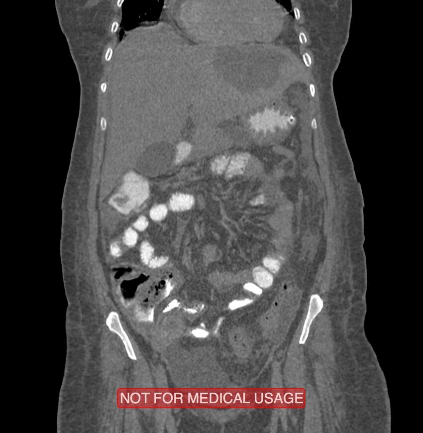 Amoebic enterocolitis with liver abscess (Radiopaedia 35100-36609 B 62).jpg