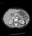 Ampulla of Vater metastasis (Radiopaedia 27820-28069 A 20).jpg
