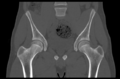 Aneurysmal bone cyst of ischium (Radiopaedia 25957-26094 Coronal bone window 18).png