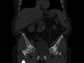 Ankylosing spondylitis (Radiopaedia 44609-48357 Coronal bone window 19).jpg