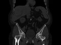 Ankylosing spondylitis (Radiopaedia 44609-48357 Coronal bone window 23).jpg