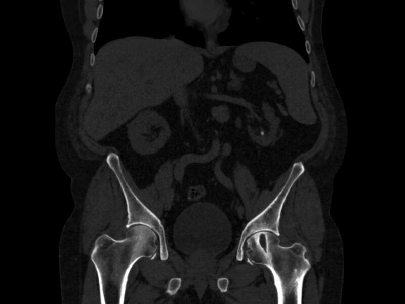 File:Ankylosing spondylitis (Radiopaedia 44609-48357 Coronal bone window 28).jpg